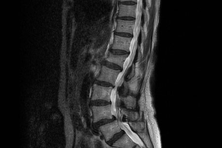 磁力共振MRI找出脊骨問題